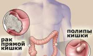 Каковы симптомы и как лечить рак прямой кишки?