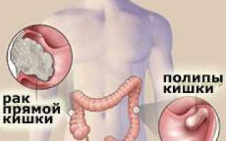 Каковы симптомы и как лечить рак прямой кишки?