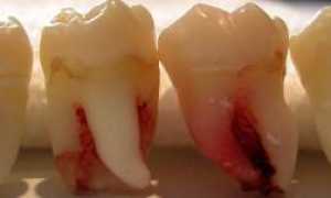 Самый распространенный вопрос стоматологам: больно ли удалять коренной зуб?