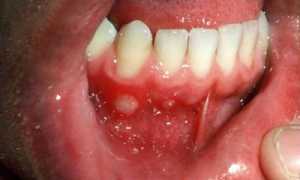 Действенно ли лечение стоматита народными средствами в домашних условиях у взрослых?