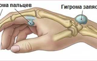 Гигрома на пальце руки