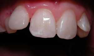 Этиология и методы лечения кариеса в стадии пятна