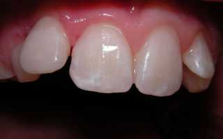 Этиология и методы лечения кариеса в стадии пятна