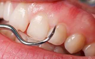 Полезно знать каждому: чем полоскать рот при пародонтозе?