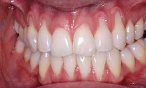 5 причин рецессии десны. Почему это важно знать?