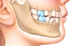 Красивая улыбка в результате интенсивных тренировок! Как исправить прикус в домашних условиях?