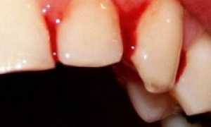 Симптомы, характерные для гингивита