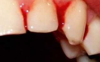 Симптомы, характерные для гингивита