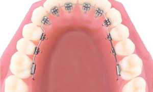 Исправление прикуса лингвальными брекетами