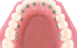 Исправление прикуса лингвальными брекетами