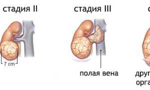 Сколько живут с раком 4 степени и метастазами?