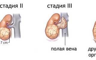Сколько живут с раком 4 степени и метастазами?