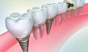 Просто ли вернуть красивую улыбку? Как происходит протезирование зубов на имплантах