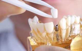 Что назначает врач после имплантации зубов: рекомендации и предостережения