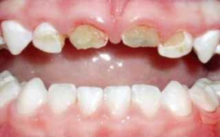 Бутылочная форма кариеса: этиология, симптоматика, методы лечения