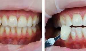 Лазерное отбеливание зубов