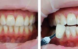 Лазерное отбеливание зубов