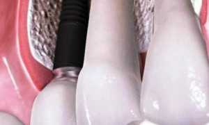 Частичное протезирование зубов. Последствия потери зубов