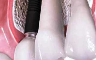 Частичное протезирование зубов. Последствия потери зубов