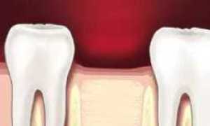 Причины возникновения боли в области удаленного зуба