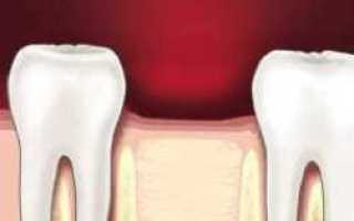 Причины возникновения боли в области удаленного зуба