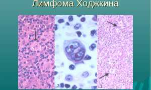 Стадии и лечение ходжкинской лимфомы