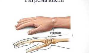 Гигрома. Что это такое?
