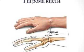 Гигрома. Что это такое?