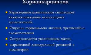Хориокарцинома: симптомы и лечение