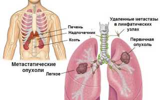 Метастазы: симптомы и диагностирование