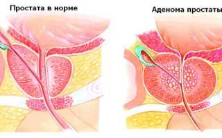 Медикаментозное лечение аденомы простаты: лекарства и свечи