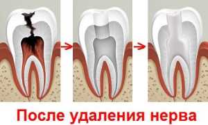 Причины возникновения зубной боли после депульпирования