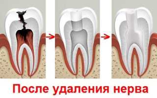 Причины возникновения зубной боли после депульпирования