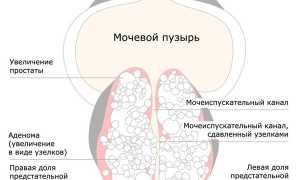 Рак и аденома предстательной железы. Симптомы и лечение