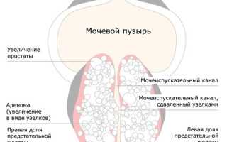 Рак и аденома предстательной железы. Симптомы и лечение