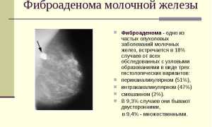 Фиброаденома молочной железы