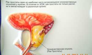 Рак предстательной железы