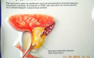 Рак предстательной железы