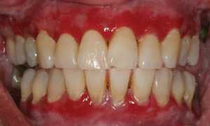 Всё, что нужно знать о гингивите: лечение и методы профилактики