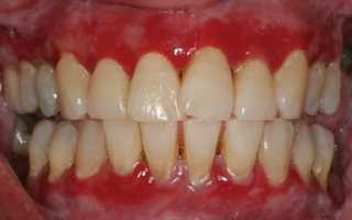 Всё, что нужно знать о гингивите: лечение и методы профилактики
