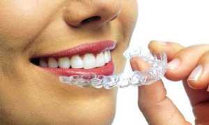 Металлические части смотрятся не эстетично? Как выровнять зубы без брекетов