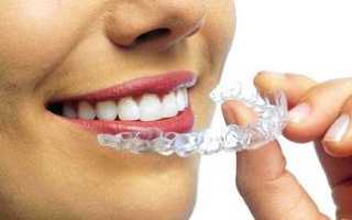 Металлические части смотрятся не эстетично? Как выровнять зубы без брекетов