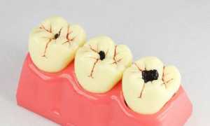 Какая классификация кариеса самая точная? Общепринятые классы