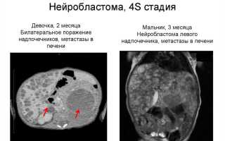 Как диагностируют нейробластную бластому?