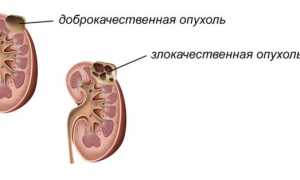 Причины возникновения бластомы почки и что это такое?