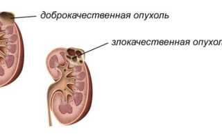 Причины возникновения бластомы почки и что это такое?