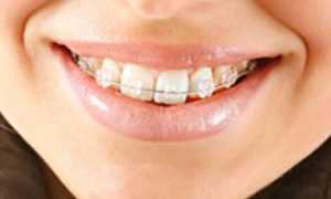 Керамические брекеты: плюсы и минусы