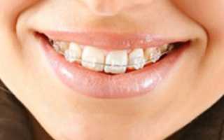 Керамические брекеты: плюсы и минусы
