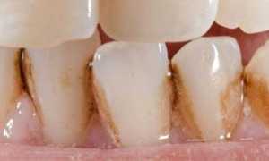 Важно знать: что такое зубной камень и как он выглядит у взрослых и детей?