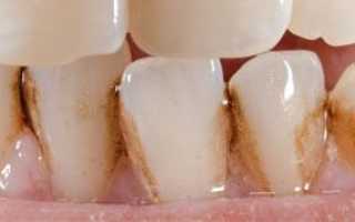 Важно знать: что такое зубной камень и как он выглядит у взрослых и детей?